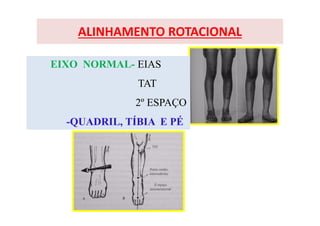ALINHAMENTO ROTACIONAL
EIXO NORMAL- EIAS
TAT
2º ESPAÇO
-QUADRIL, TÍBIA E PÉ
 