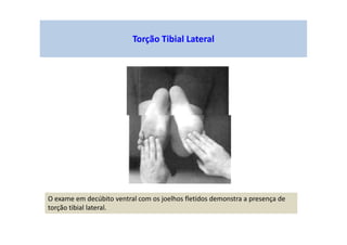 Torção Tibial Lateral
O exame em decúbito ventral com os joelhos fletidos demonstra a presença de
torção tibial lateral.
 