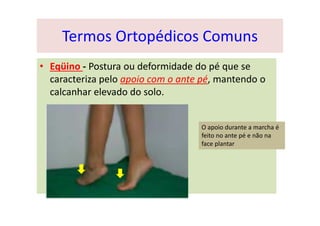 Termos Ortopédicos Comuns
• Eqüino - Postura ou deformidade do pé que se
caracteriza pelo apoio com o ante pé, mantendo o
calcanhar elevado do solo.
O apoio durante a marcha é
feito no ante pé e não na
face plantar
 