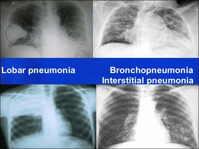 l9 10 lung consolidation cancer and pneumonia