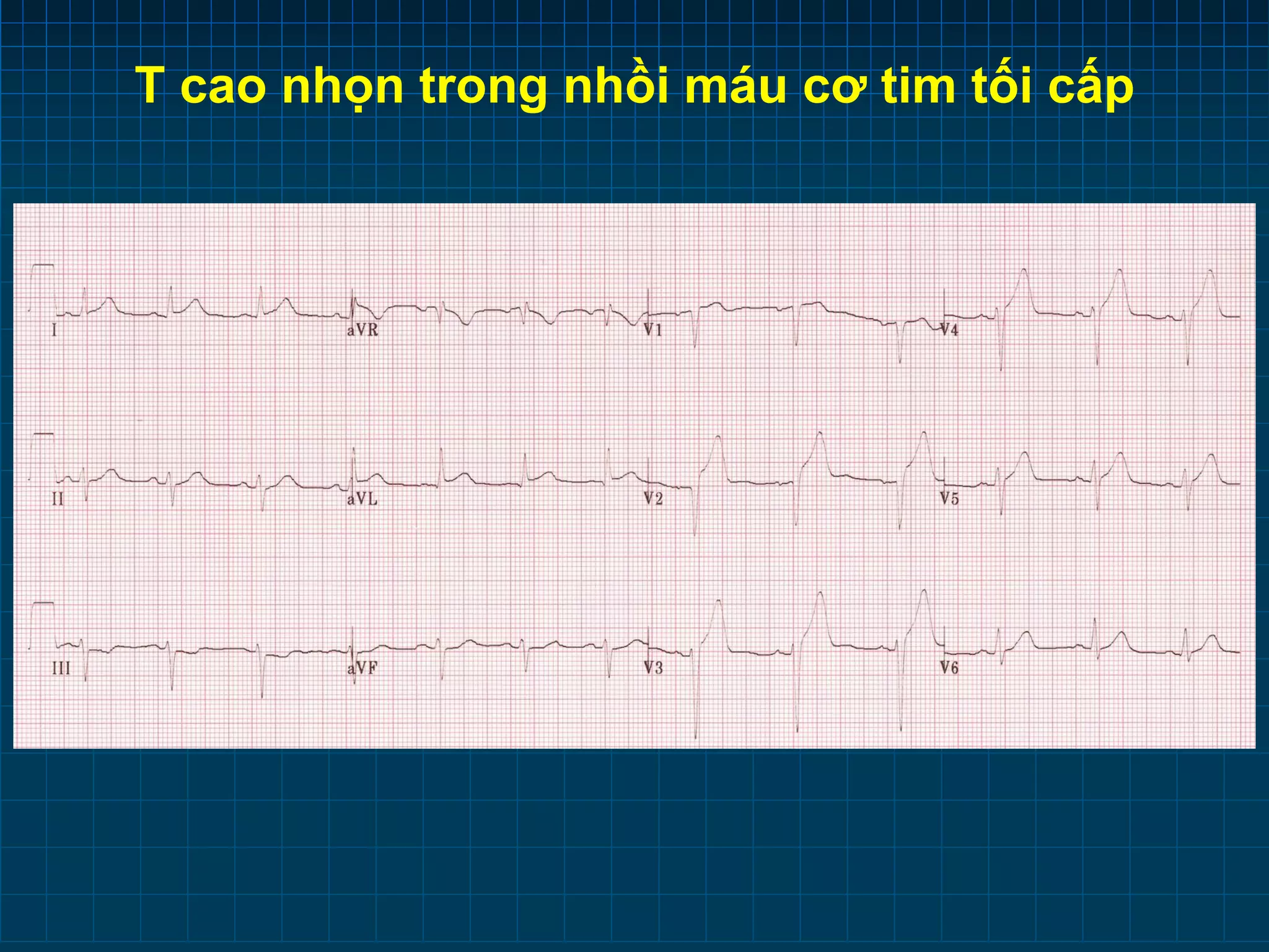 ECG THIẾU MÁU CƠ TIM | PDF