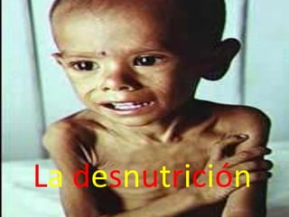 Ladesnutrición 