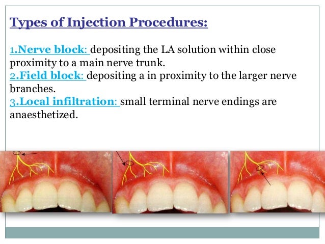 Anesthesia Block Types maxillary-injection-sites-dental-hygiene-school-dentistry-dental