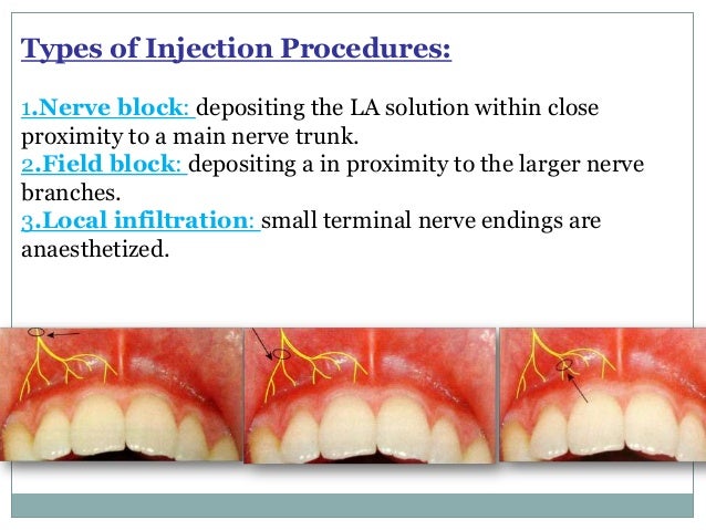 Anesthesia Block Types