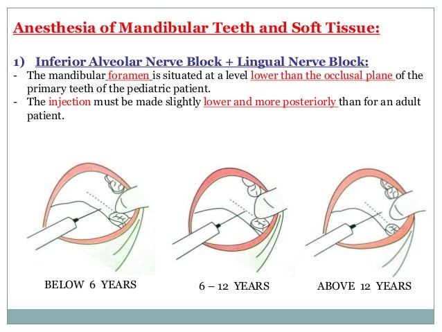 inferior alveolar nerve block
