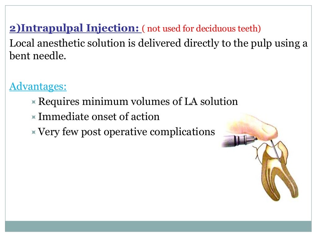 Local Anesthesia for pediatric dentistry