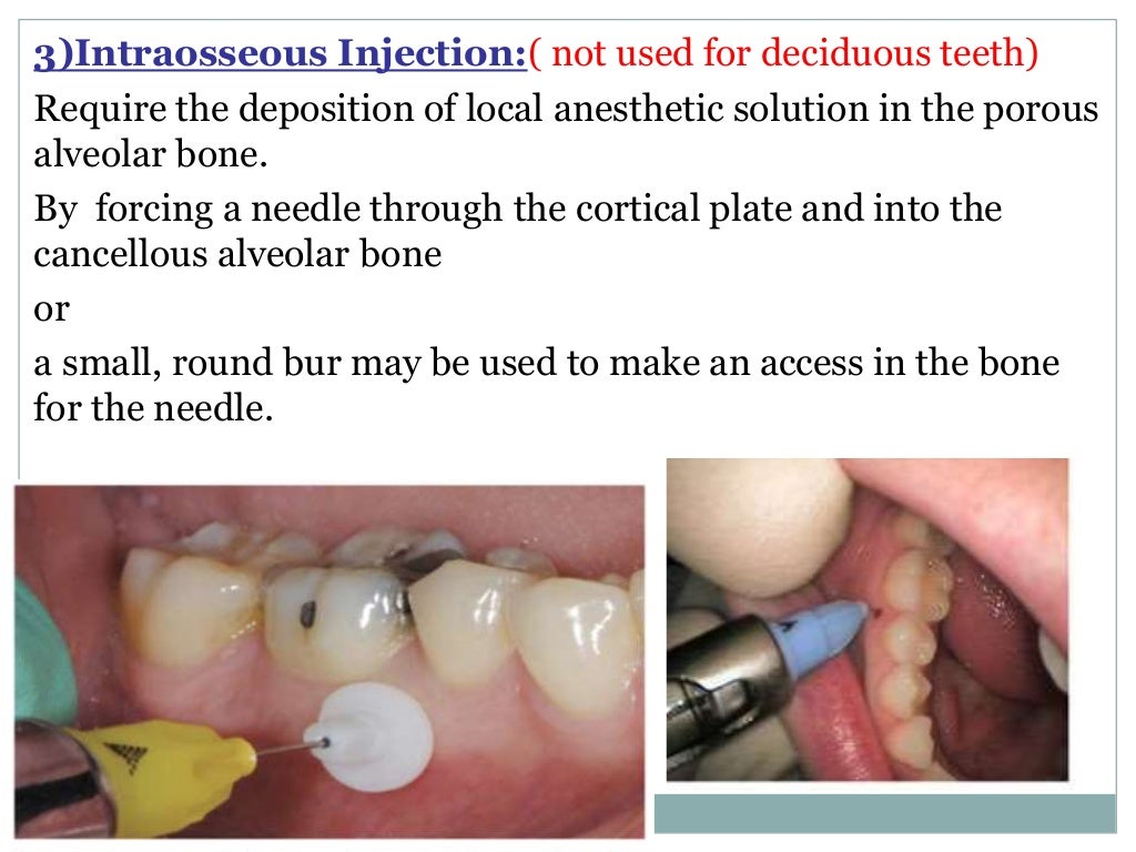 Local Anesthesia for pediatric dentistry