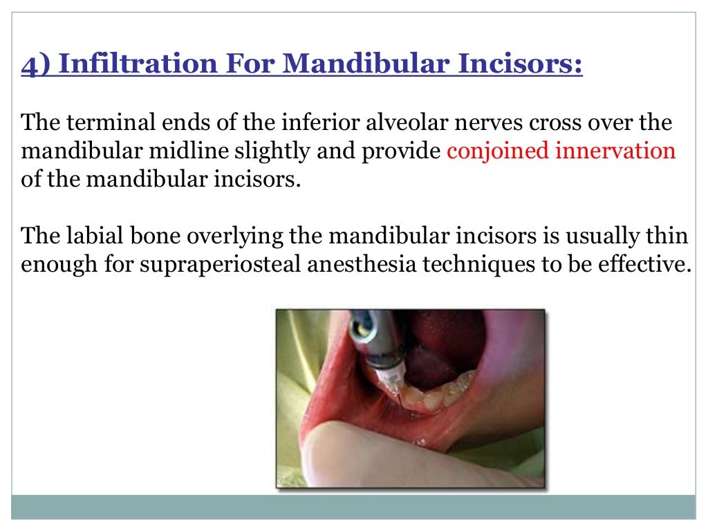 Local Anesthesia for pediatric dentistry