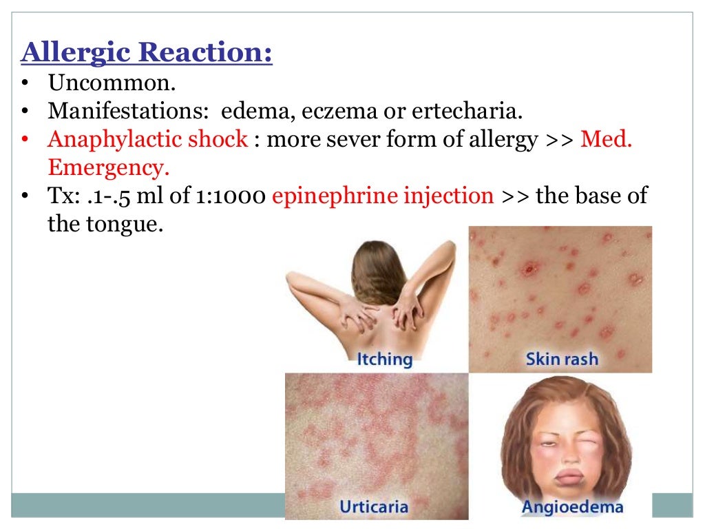 Local Anesthesia for pediatric dentistry