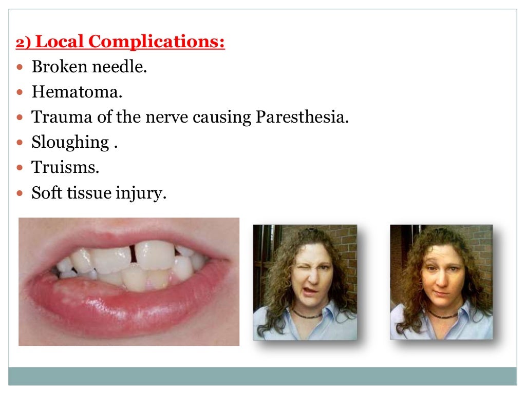Local Anesthesia for pediatric dentistry