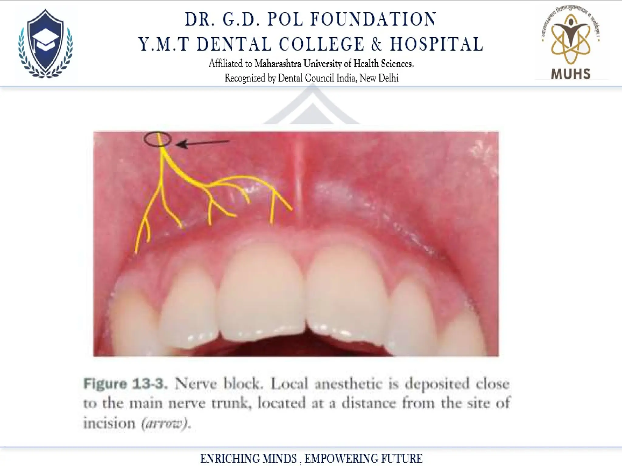 Local Anesthesia Powerpoint Presentation Ppt