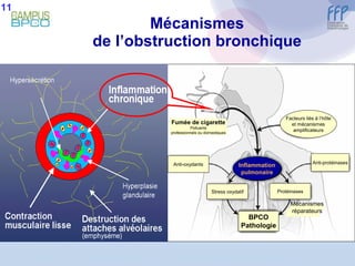 Mécanismes de l’obstruction bronchique 11 