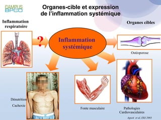 Organes-cible et expression de l’inflammation systémique Inflammation  respiratoire Organes cibles Inflammation  systémique ? Agusti  et al, ERJ 2003 Pathologies Cardiovasculaires Dénutrition Cachexie Fonte musculaire Ostéoporose 