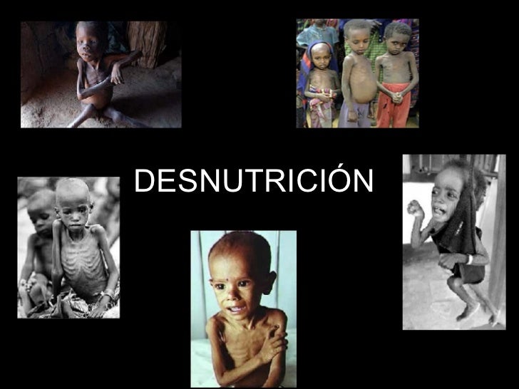 La desnutricion