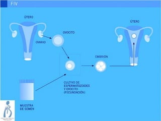 LA FECUNDACIÓN IN VITRO
