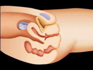 LA FECUNDACIÓN IN VITRO