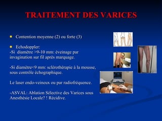 TRAITEMENT DES VARICES Contention moyenne (2) ou forte (3) Echodoppler: -Si  diamètre >9-10 mm: éveinage par  invagination sur fil après marquage. -Si diamètre<9 mm: sclérothérapie à la mousse,  sous contrôle échographique. Le laser endo-veineux ou par radiofréquence. -ASVAL: Ablation Sélective des Varices sous Anesthésie Locale? ! Récidive. 