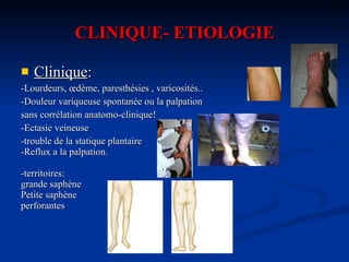 CLINIQUE- ETIOLOGIE Clinique : -Lourdeurs, œdème, paresthésies , varicosités.. -Douleur variqueuse spontanée ou la palpation  sans corrélation anatomo-clinique! -Ectasie veineuse -trouble de la statique plantaire -Reflux a la palpation.  -territoires: grande saphène Petite saphène perforantes 