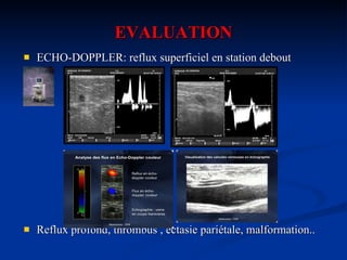 EVALUATION ECHO-DOPPLER: reflux superficiel en station debout Reflux profond, thrombus , ectasie pariétale, malformation.. 