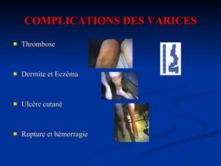 COMPLICATIONS DES VARICES Thrombose Dermite et Eczéma Ulcère cutané Rupture et hémorragie 