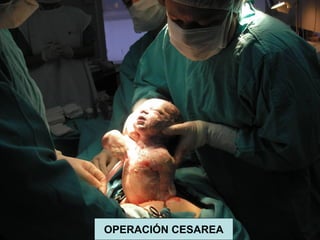 CESÁREA
OPERACIÓN CESAREA
 