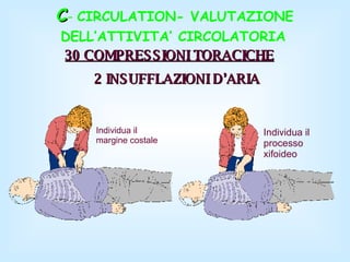 C -  CIRCULATION- VALUTAZIONE DELL’ATTIVITA’ CIRCOLATORIA   30 COMPRESSIONI TORACICHE   2 INSUFFLAZIONI D’ARIA Individua il margine costale Individua il  processo  xifoideo 