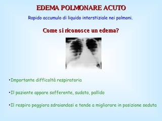 Come si riconosce un edema?   EDEMA POLMONARE ACUTO Rapido accumulo di liquido interstiziale nei polmoni.  Importante difficoltà respiratoria  Il paziente appare sofferente, sudato, pallido Il respiro peggiora sdraiandosi e tende a migliorare in posizione seduta 