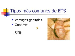 Tipos más comunes de ETS
 Verrugas genitales
 Gonorrea
Sífilis
 