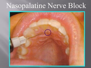 Nasopalatine Nerve Block
 