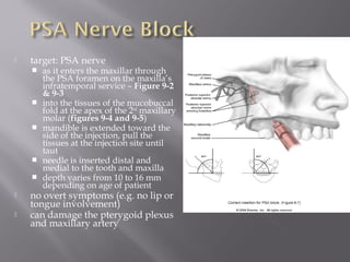  target: PSA nerve
 as it enters the maxillar through
the PSA foramen on the maxilla’s
infratemporal service – Figure 9-2
& 9-3
 into the tissues of the mucobuccal
fold at the apex of the 2nd
maxillary
molar (figures 9-4 and 9-5)
 mandible is extended toward the
side of the injection, pull the
tissues at the injection site until
taut
 needle is inserted distal and
medial to the tooth and maxilla
 depth varies from 10 to 16 mm
depending on age of patient
 no overt symptoms (e.g. no lip or
tongue involvement)
 can damage the pterygoid plexus
and maxillary artery
 