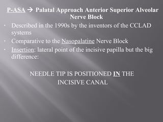 P-ASA  Palatal Approach Anterior Superior Alveolar
Nerve Block
• Described in the 1990s by the inventors of the CCLAD
systems
• Comparative to the Nasopalatine Nerve Block
• Insertion: lateral point of the incisive papilla but the big
difference:
NEEDLE TIP IS POSITIONED IN THE
INCISIVE CANAL
 