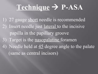 Technique  P-ASA
1) 27 gauge short needle is recommended
2) Insert needle just lateral to the incisive
papilla in the papillary groove
3) Target is the nasopalatine foramen
4) Needle held at 45 degree angle to the palate
(same as central incisors)
 