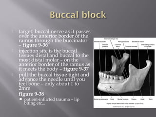  target: buccal nerve as it passes
over the anterior border of the
ramus through the buccinator
– figure 9-36
 injection site is the buccal
tissues distal and buccal to the
most distal molar – on the
anterior border of the ramus as
it meets the body – figure 9-37
 pull the buccal tissue tight and
advance the needle until you
feel bone – only about 1 to
2mm
figure 9-38
 patient-inflicted trauma – lip
biting etc...
 