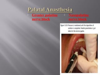  Greater palatine
nerve block
 Nasopalatine
nerve block
161
 