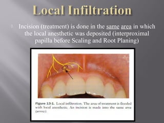  Incision (treatment) is done in the same area in which
the local anesthetic was deposited (interproximal
papilla before Scaling and Root Planing)
 