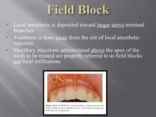 • Local anesthetic is deposited toward larger nerve terminal
branches
• Treatment is done away from the site of local anesthetic
injection
• Maxillary injections administered above the apex of the
tooth to be treated are properly referred to as field blocks
not local infiltrations
 