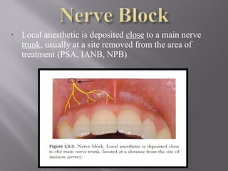 • Local anesthetic is deposited close to a main nerve
trunk, usually at a site removed from the area of
treatment (PSA, IANB, NPB)
 
