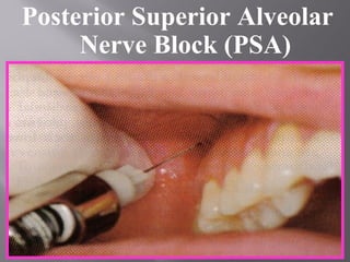 Posterior Superior Alveolar
Nerve Block (PSA)
 