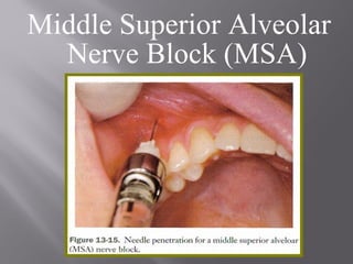 Middle Superior Alveolar
Nerve Block (MSA)
 