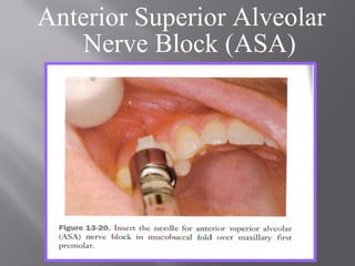 Anterior Superior Alveolar
Nerve Block (ASA)
 