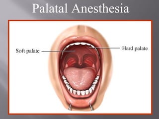Palatal Anesthesia
 
