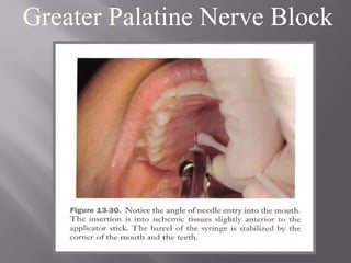 Greater Palatine Nerve Block
 