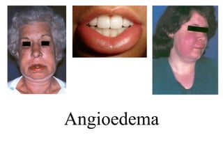 Angioedema
 