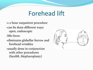 Forehead lift
-1-2 hour outpatient procedure
-can be done different ways:
   open, endoscopic
-lifts brow
-eliminates glabellar furrow and
   forehead wrinkles
-usually done in conjunction
   with other procedures
   (facelift, blepharoplasty)
 