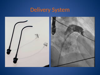 Watchman Gutter left atrial appendage closure with watchman device | PPTX