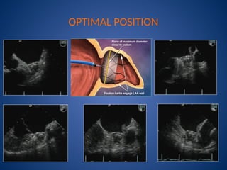 Watchman Device Pdf left atrial appendage closure with watchman device | PPTX