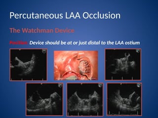 Watchman Device Pdf left atrial appendage closure with watchman device | PPTX