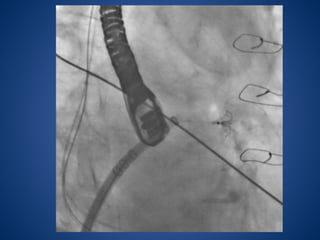 Watchman Device Pdf left atrial appendage closure with watchman device | PPTX