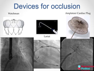 Devices for occlusion 
Amplatzer Cardiac Plug 
Lariat 
Watchman 
 
