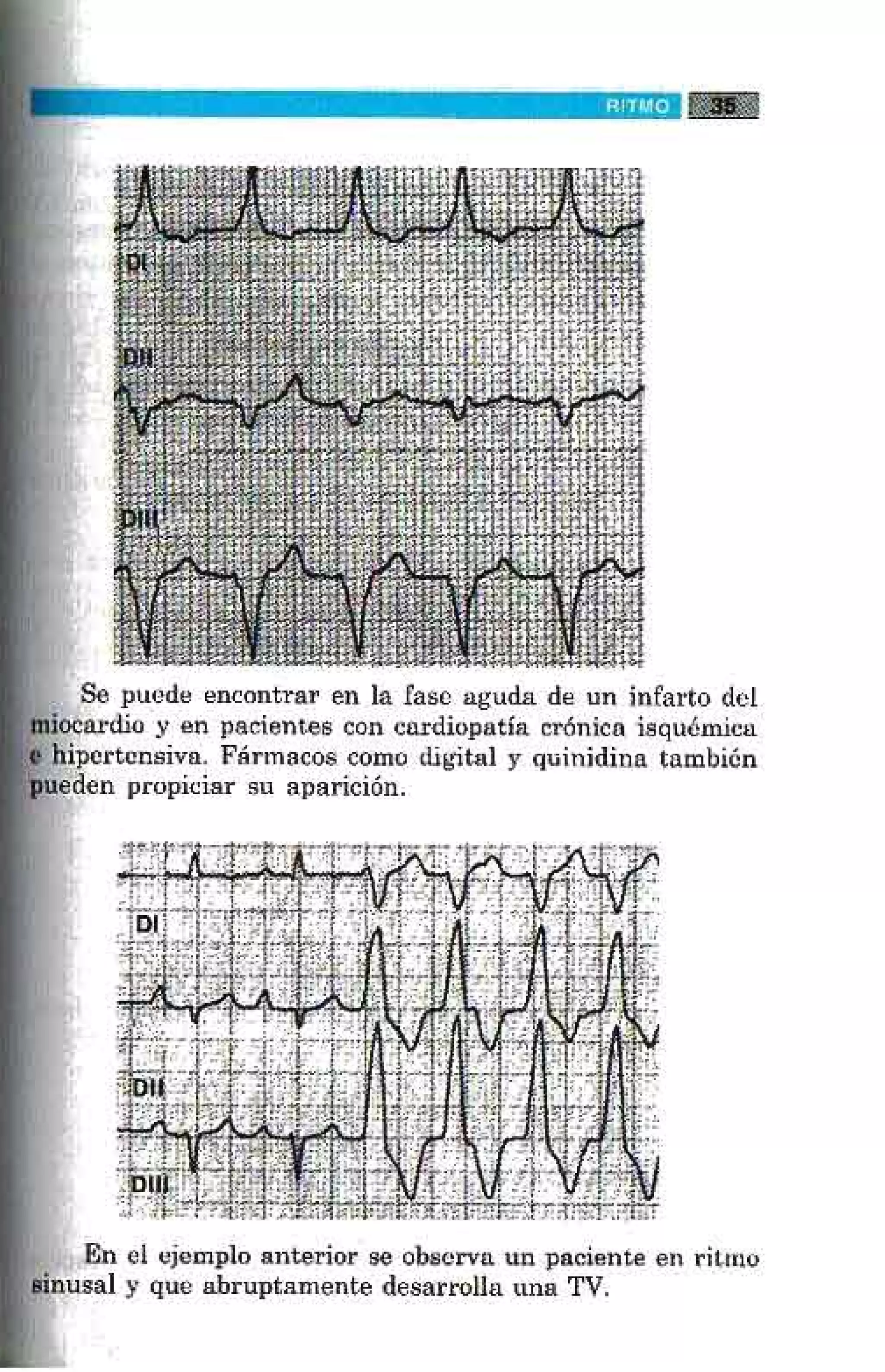 LA ALEGRIA DE LEER EL ELECTROCARDIOGRAMA